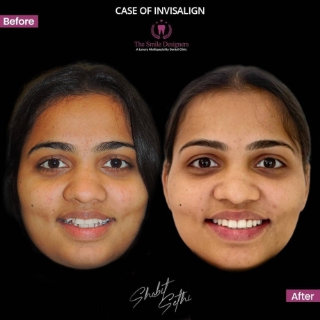 Best Dental Clinic in Mohali -Braces Cases