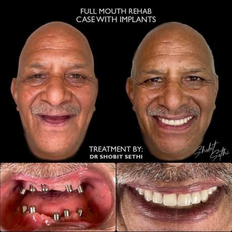 dental clinic mohali - dental implant case sucessfull