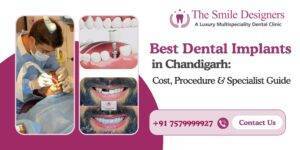 Best Dental Implants in Chandigarh: Cost, Procedure & Specialist Guide