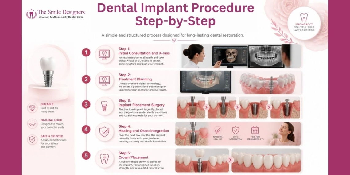 Dental Implant Procedure Step-by-Step