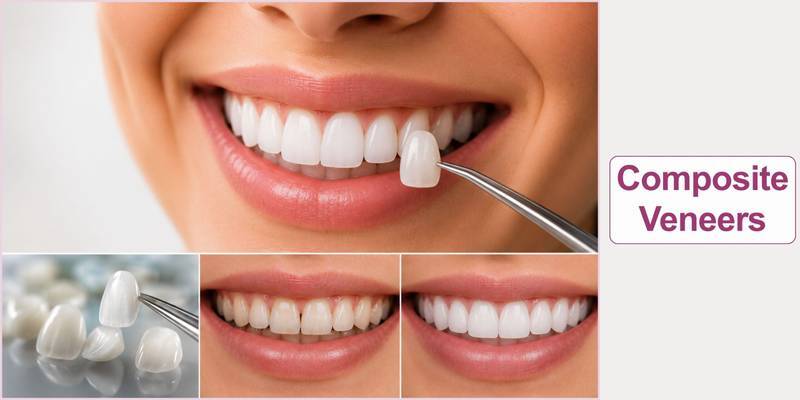 Composite Veneers