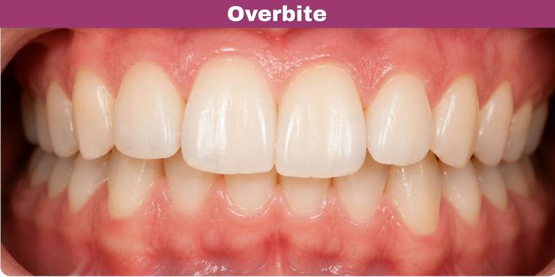 What is an Overbite