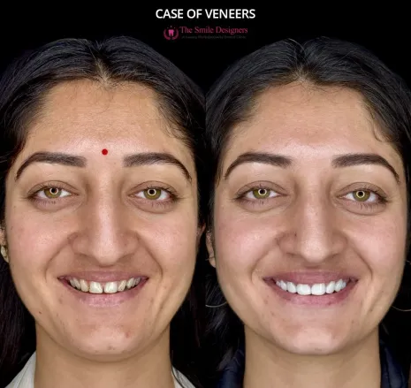 Veneers Before and After Photos - The Smile Designers - Best Dentist in Mohai Chandigarh