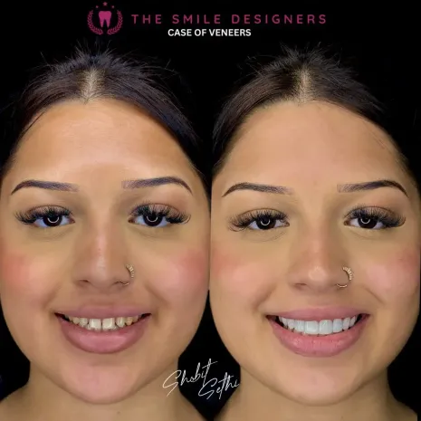 Veneers Before After Pics- The Smile Designers - Best Dentist In Chandigarh
