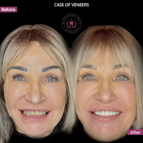 Best Dentist in Chandigarh Mohali Before-After-Photos- The Smile Designers