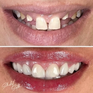 Dental implant