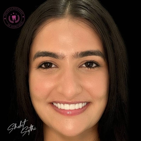 Best Dentist in Mohali - veneers cases