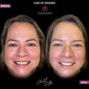 The Smile Designers -veneers