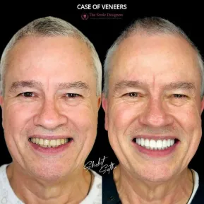 Best Dental Clinic in Chandigarh Mohali Before-After-Venners-Patient-Photos - The Smile Designers