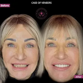 Best Dentist in Chandigarh Mohali Before-After-Photos- The Smile Designers