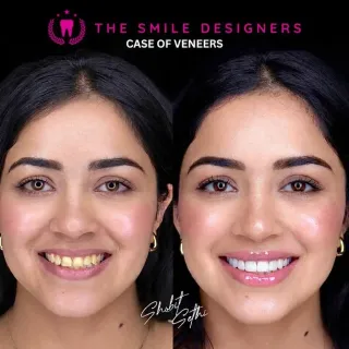 Best Dentist in Chandigarh Mohali Before-After-Smile Design-Patient-Photos - The Smile Designers