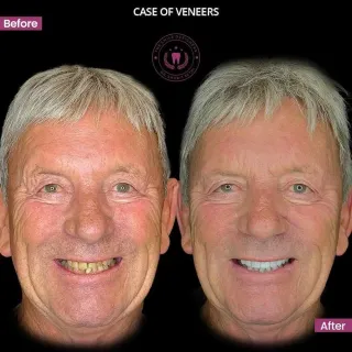 Best Dentist in Chandigarh Mohali Before-After-Veneers -Patient-Photos - The Smile Designers