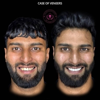 teeth gap removed and veneers