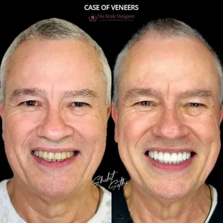 Best Dental Clinic in Chandigarh Mohali Before-After-Venners-Patient-Photos - The Smile Designers