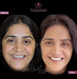 Best Dentist in Chandigarh Mohali Before-After-Patient-Photos - The Smile Designers