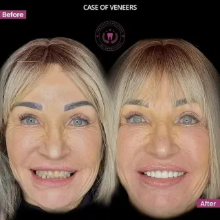 Best Dentist in Chandigarh Mohali Before-After-Photos- The Smile Designers