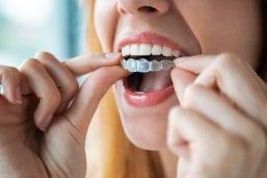 The Cost of Invisalign: Understanding The Factors That Influence The Price