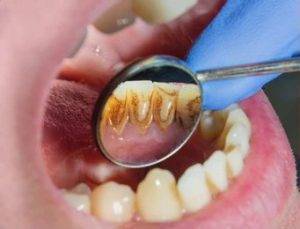 How To Prevent Dental Decay