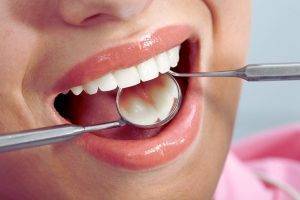 Safeguarding Your Smile: A Guide to Dental Fillings