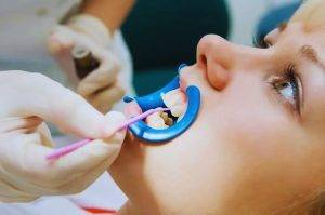 Shielding Your Smile: The Power of Dental Fissure Sealants