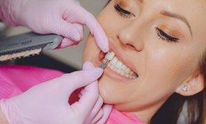 The Lifespan of Dental Veneers : How Long Do They Last?