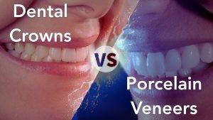 Dental Veneers vs. Dental Crowns: Understanding the Differences