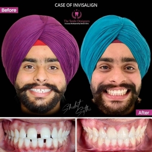 invisible braces at chandigarh - invisalign braces