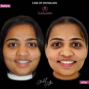 best invisible braces at chandigarh