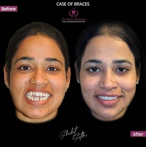 invisible braces at chandigarh - invisalign braces