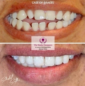 invisible braces at chandigarh - invisalign braces