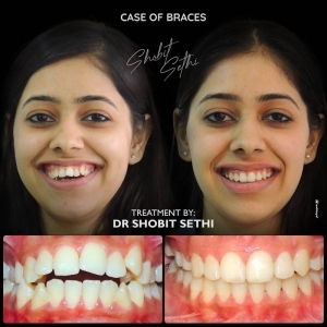 braces specialist in chandigarh