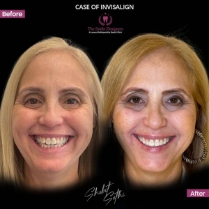invisible braces at chandigarh
