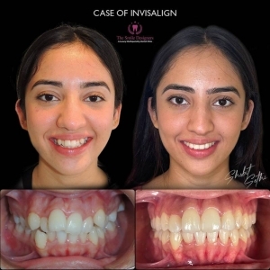 invisible braces at mohali