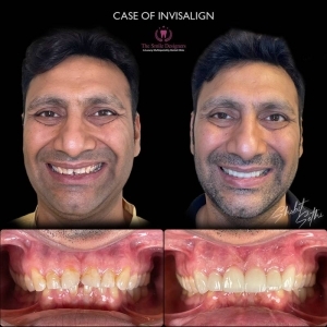 best braces specialist in chandigarh