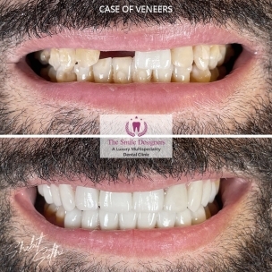 Dental implant