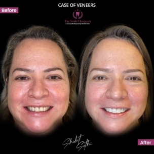 Smile Makeover