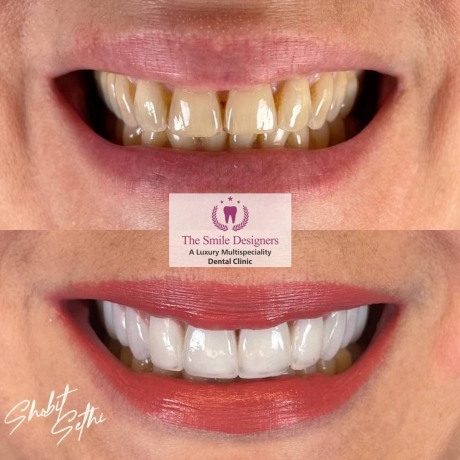 top best dentist in mohali - veneers cases
