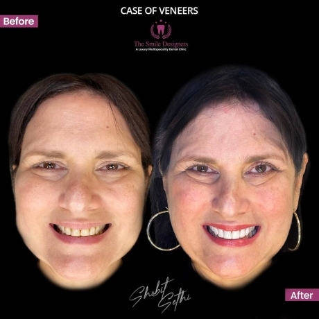 Top Best dentist near by me - veneers cases