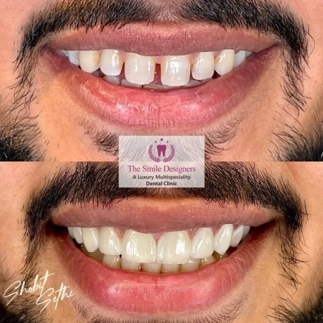 Top Best dentist near me- veneers cases