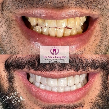 Top Best dentist in mohali - veneers cases