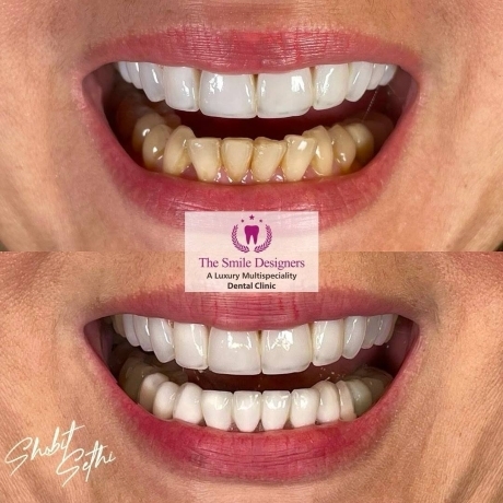 Mohali Best Dentist - veneers cases