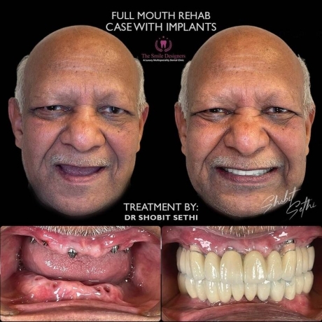 best dentist in mohali - dental implant