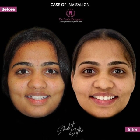 Best Dental Clinic in Mohali -Braces Cases