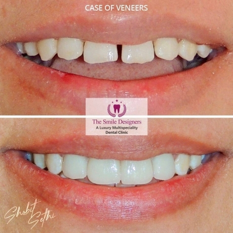 Dental clinic in mohali - veneers cases