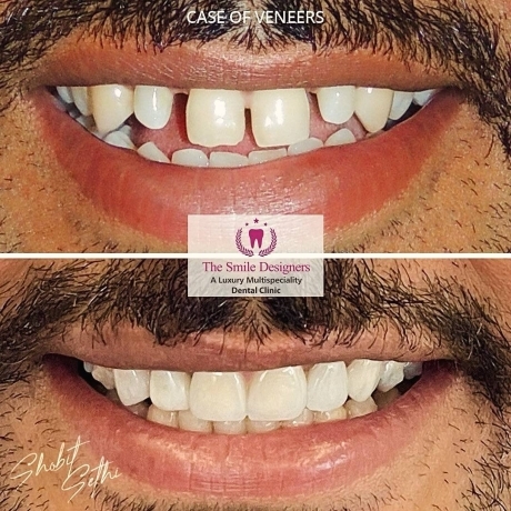 Mohali Dental Clinic - veneers cases