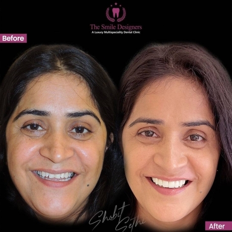 Top Best dentist near by me - veneers cases