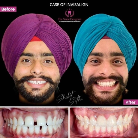Best Dentist Mohali -Braces Cases