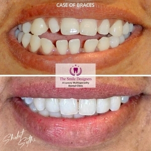 teeth gap