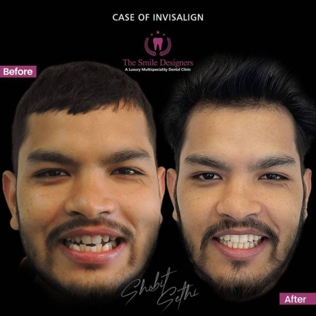 Top Best Dentist in Mohali -Braces Cases