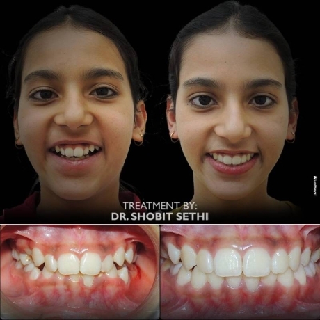 Dental Clinic in Mohali -Braces Cases